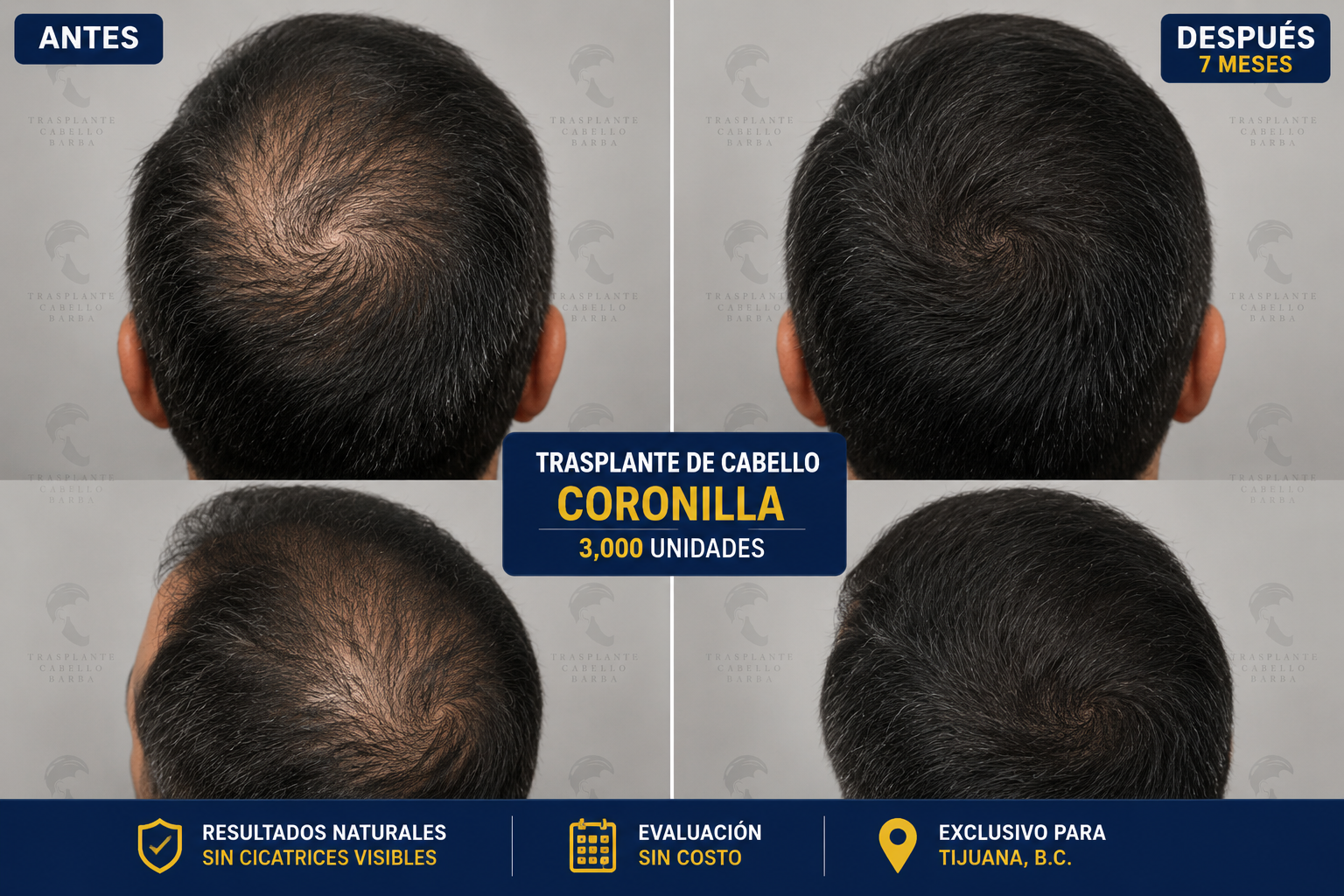 Trasplante capilar coronilla antes y despues Tijuana