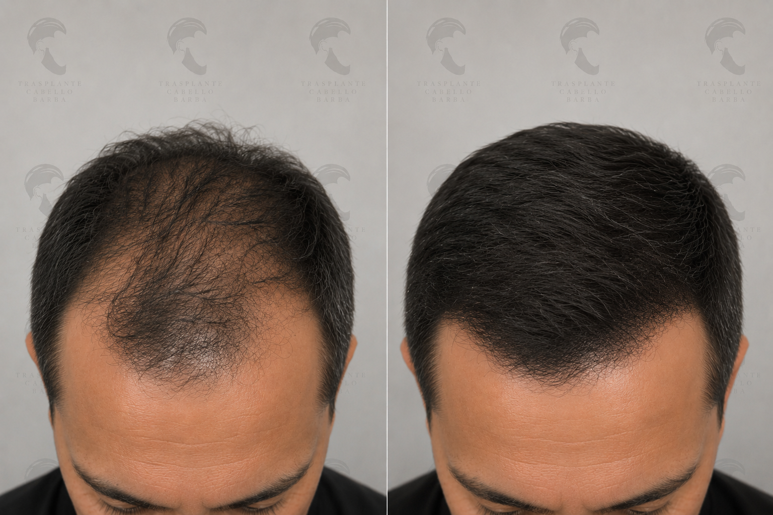Trasplante capilar linea frontal antes y despues Tijuana