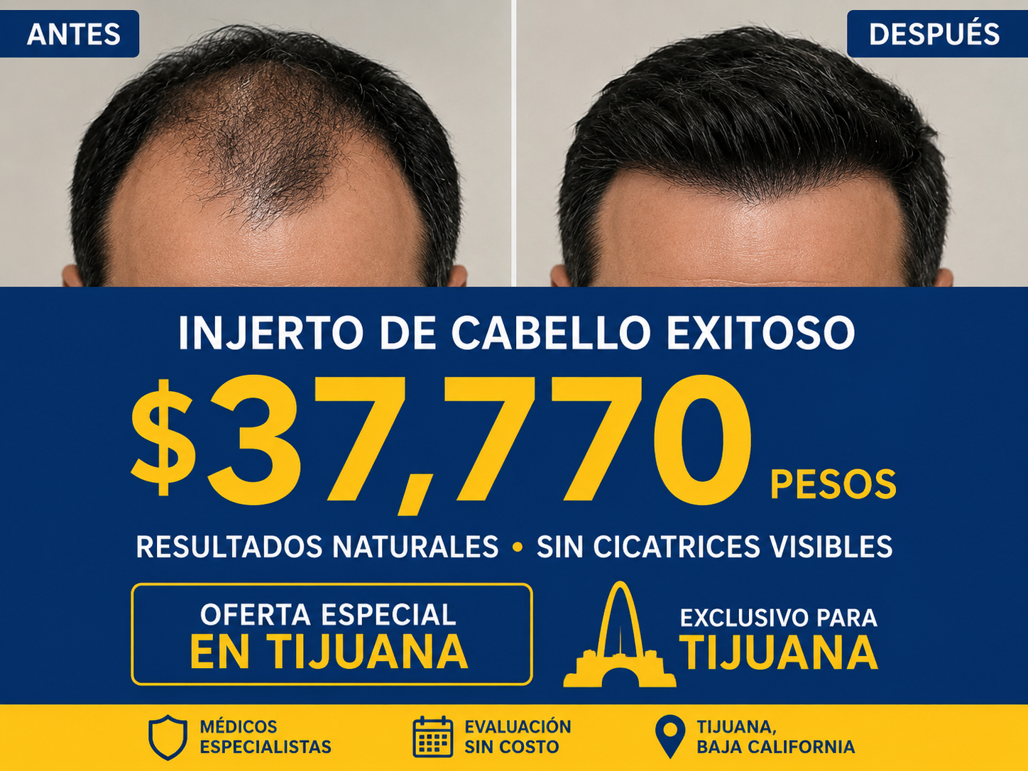 Trasplante Capilar FUE $37,770 MXN en promoción — IHTC Capilaris Tijuana